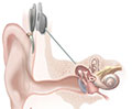 illustration of a cochlear implant (NIH)