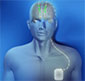 Medtronic illustration of body with brain stimulation device