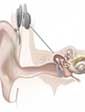 drawing of a cochlear implant