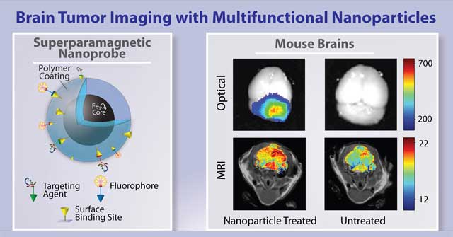 Diagram of Brain Tumor Imaging