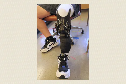 Leg with prosthetic socket