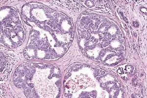 a biopsy image of ductal carcinoma in situ